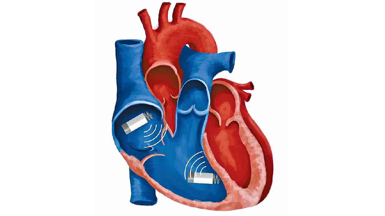 心臟起搏器新發展