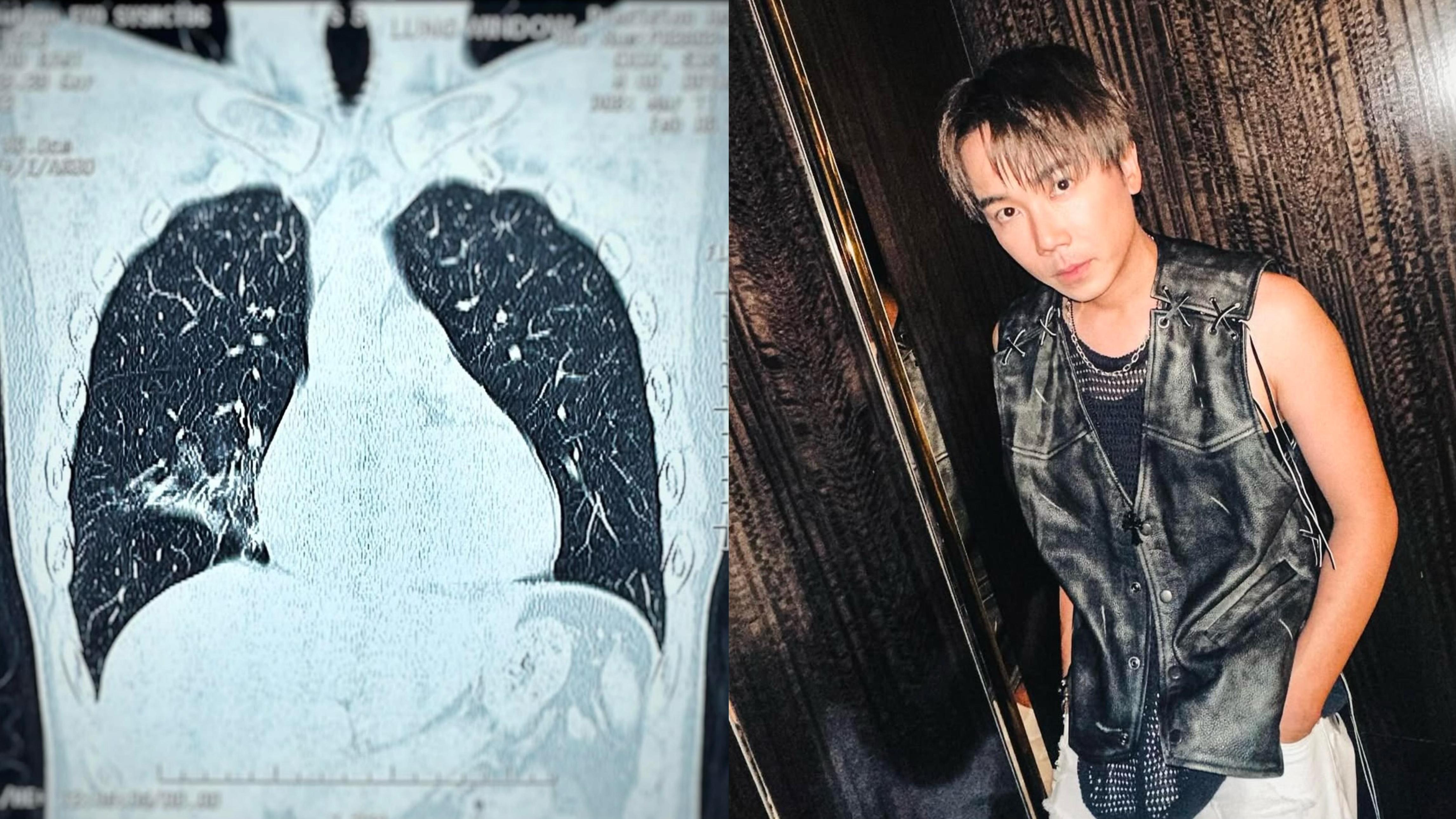 ToNick主音恆仔狂咳致肺花 堅持照開騷：可能會有少少失準 