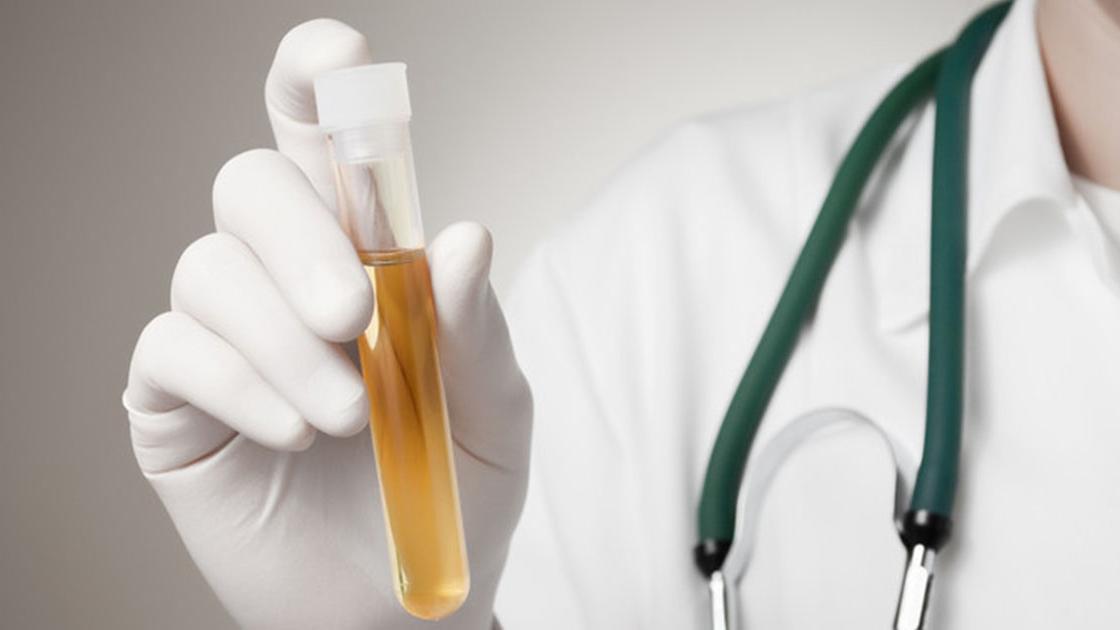 PCA3新型前列腺癌抗原3