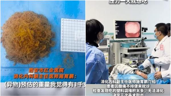 陝西女「異食癖」食膠袋6年　醫生開刀清出1公斤膠料