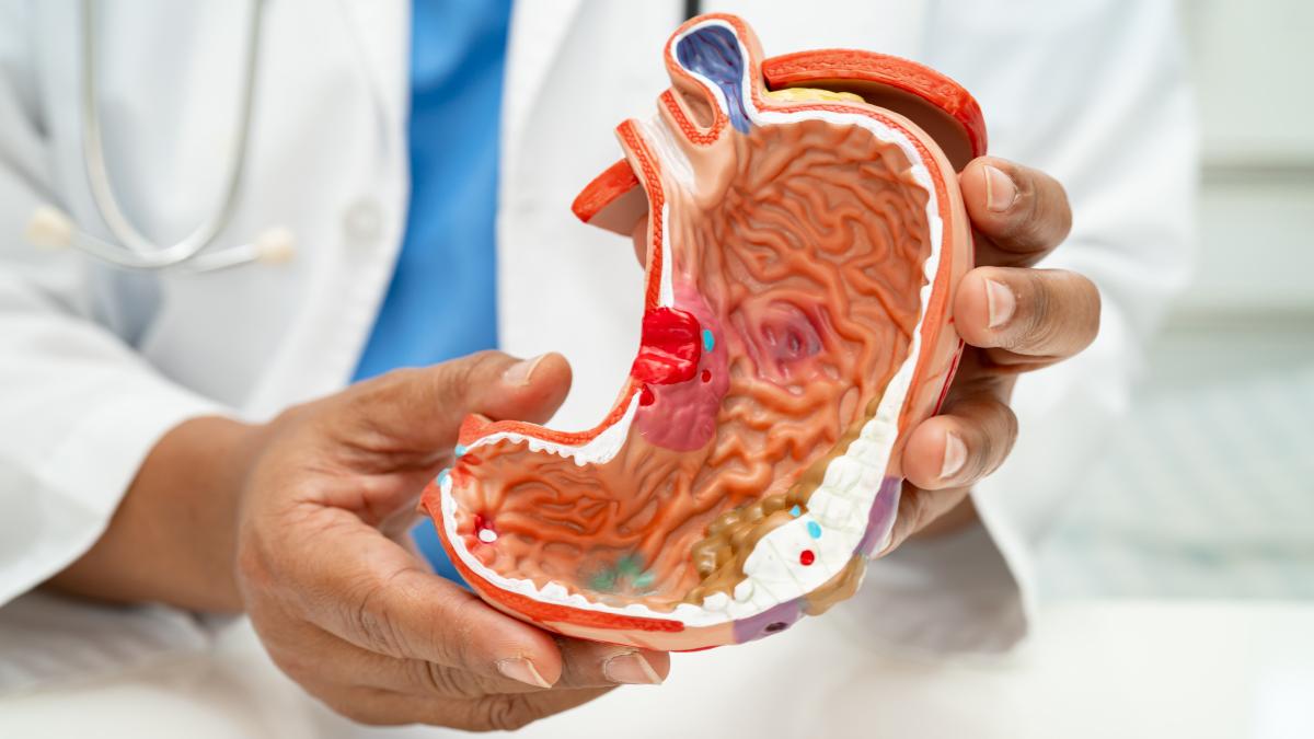 幽門螺旋桿菌是胃癌的重要風險因素之一