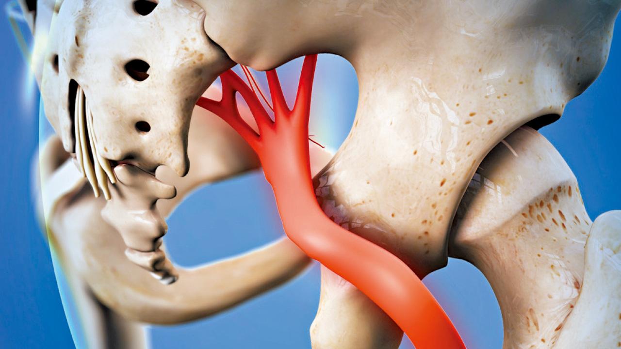 辨清「非腰椎」性坐骨神經痛