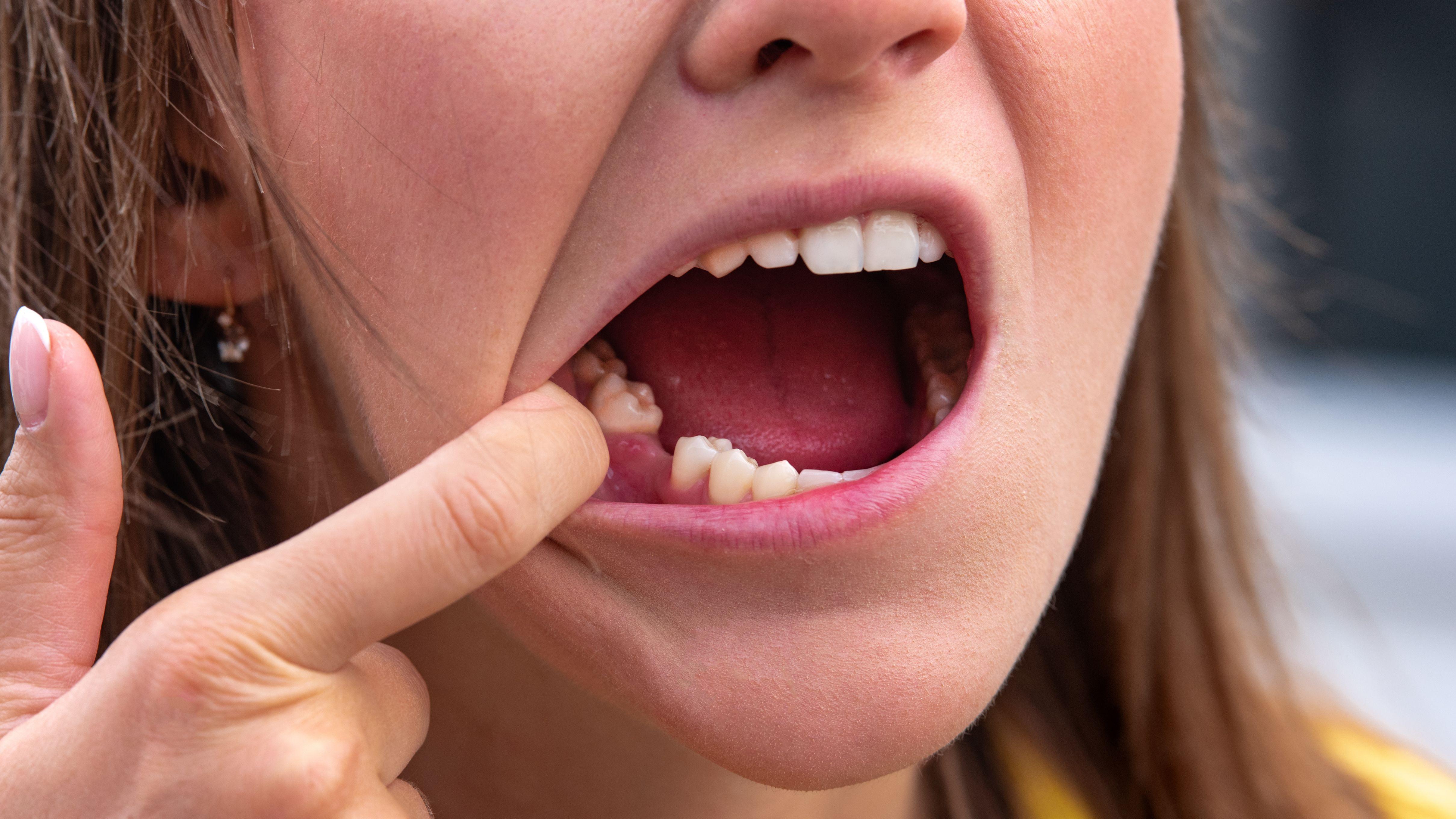 肥胖 牙齒 甩牙 牙齒健康 肥胖基因 牙周病 糖酵解 齒槽骨 體重管理 鈣質 飲食調整