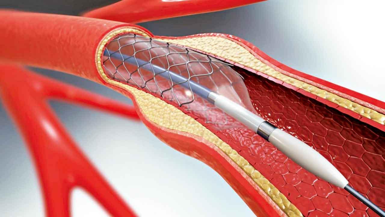 藥物塗層支架 防止血管「一塞再塞」