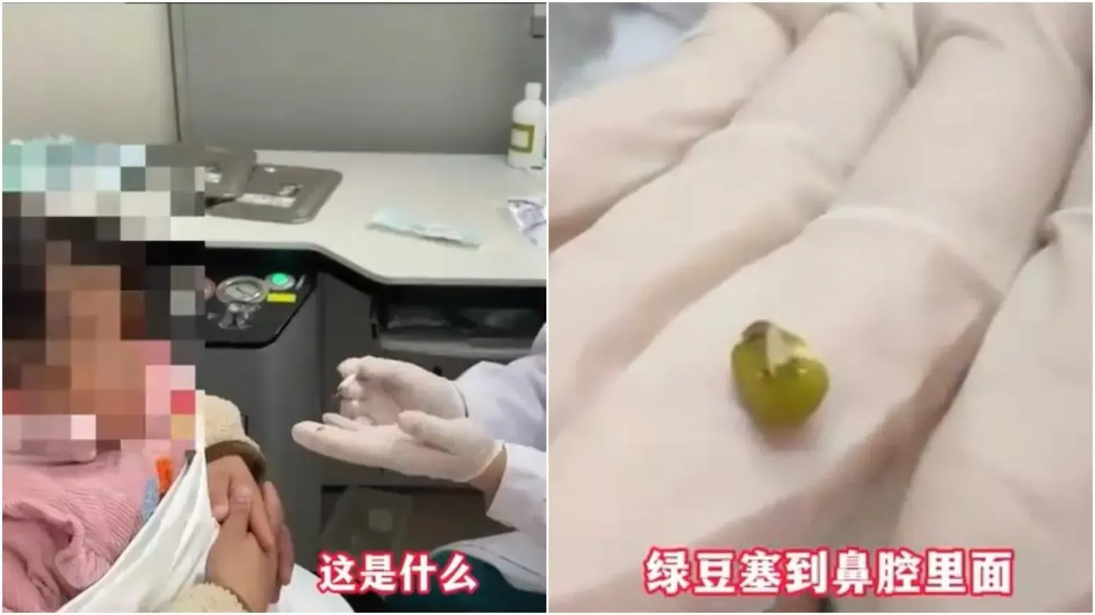 湖北童流鼻涕不止　醫生發現鼻孔竟藏已發芽綠豆