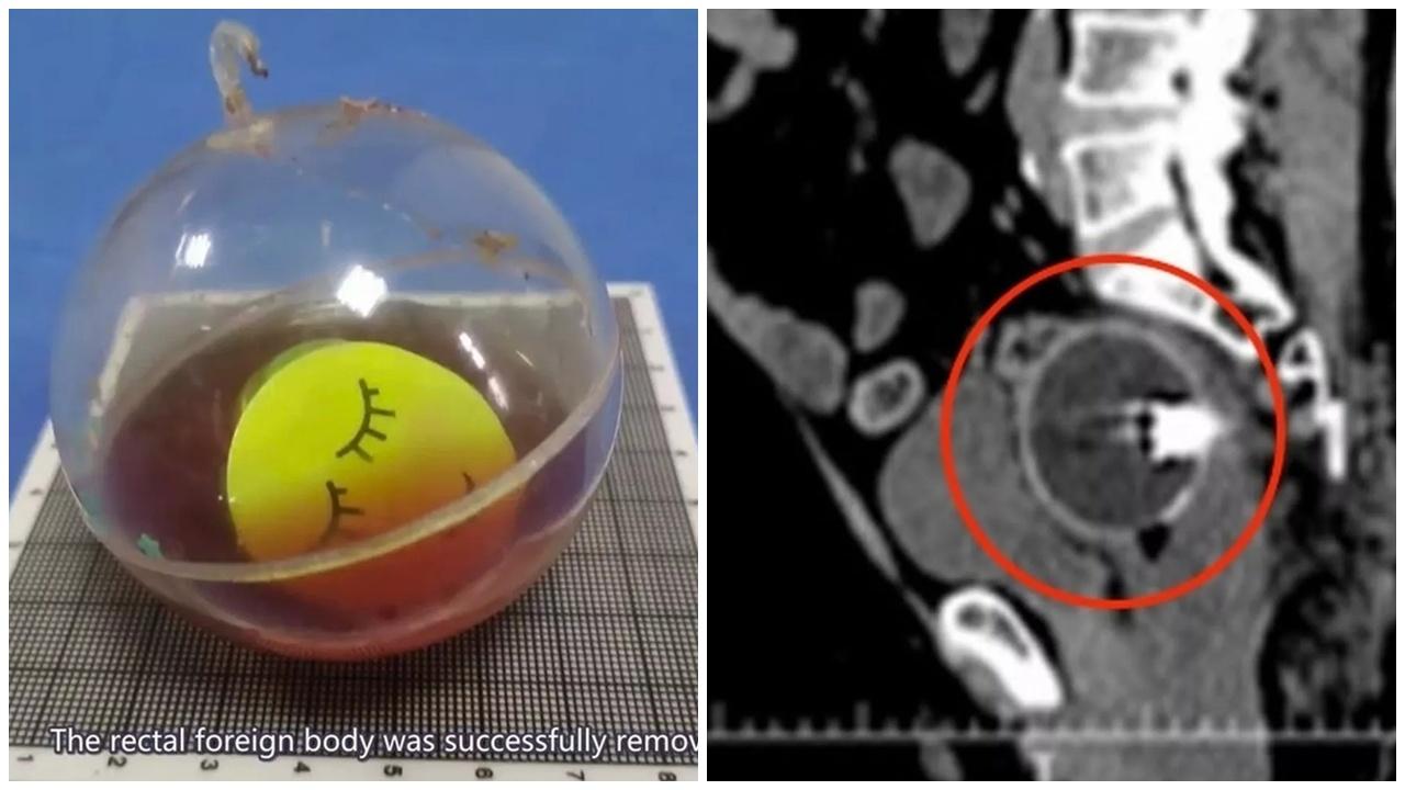 六旬漢將閃光球塞肛門超痛卡直腸，醫生妙計取出。(ScienceDirect)