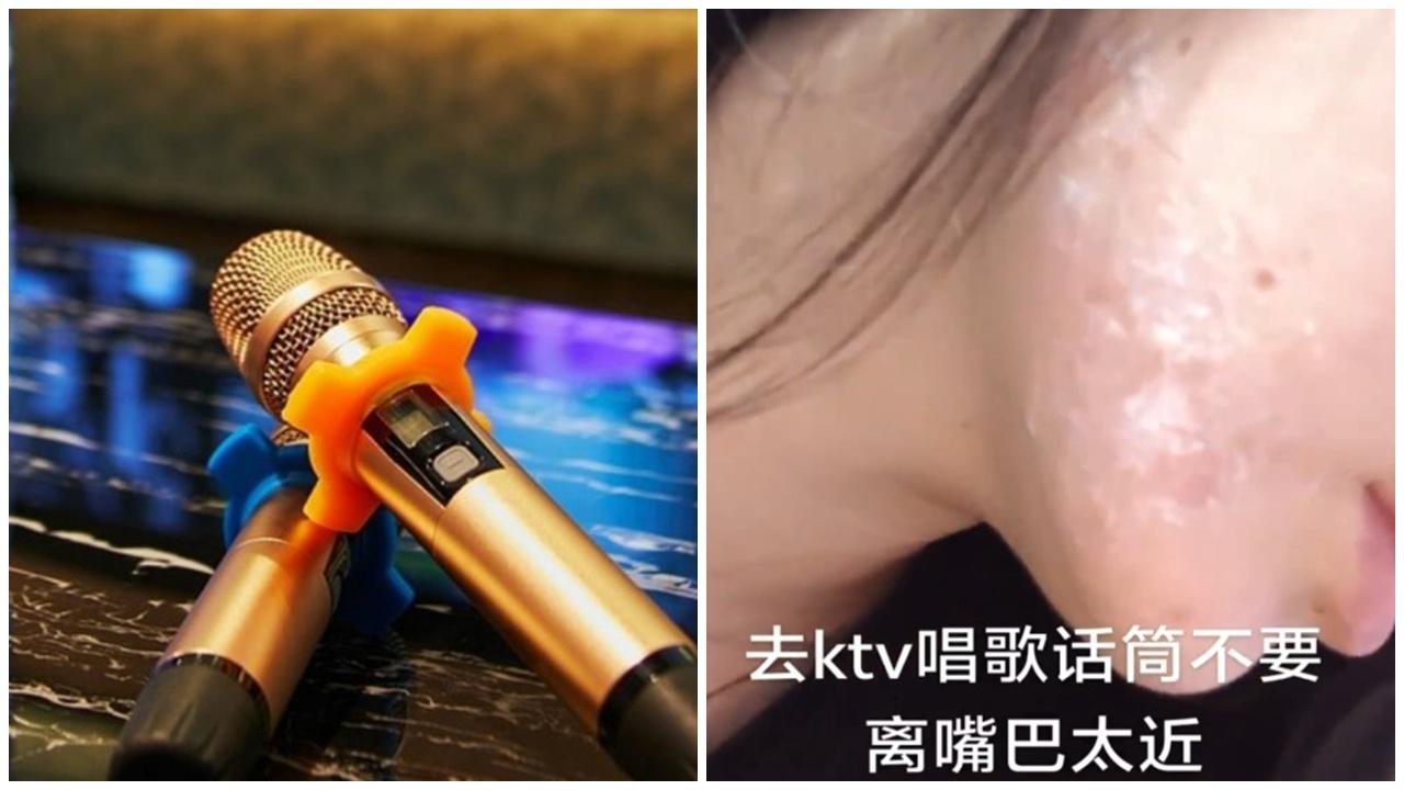 浙江女唱K太近咪高峰，感染爛面無藥可醫。