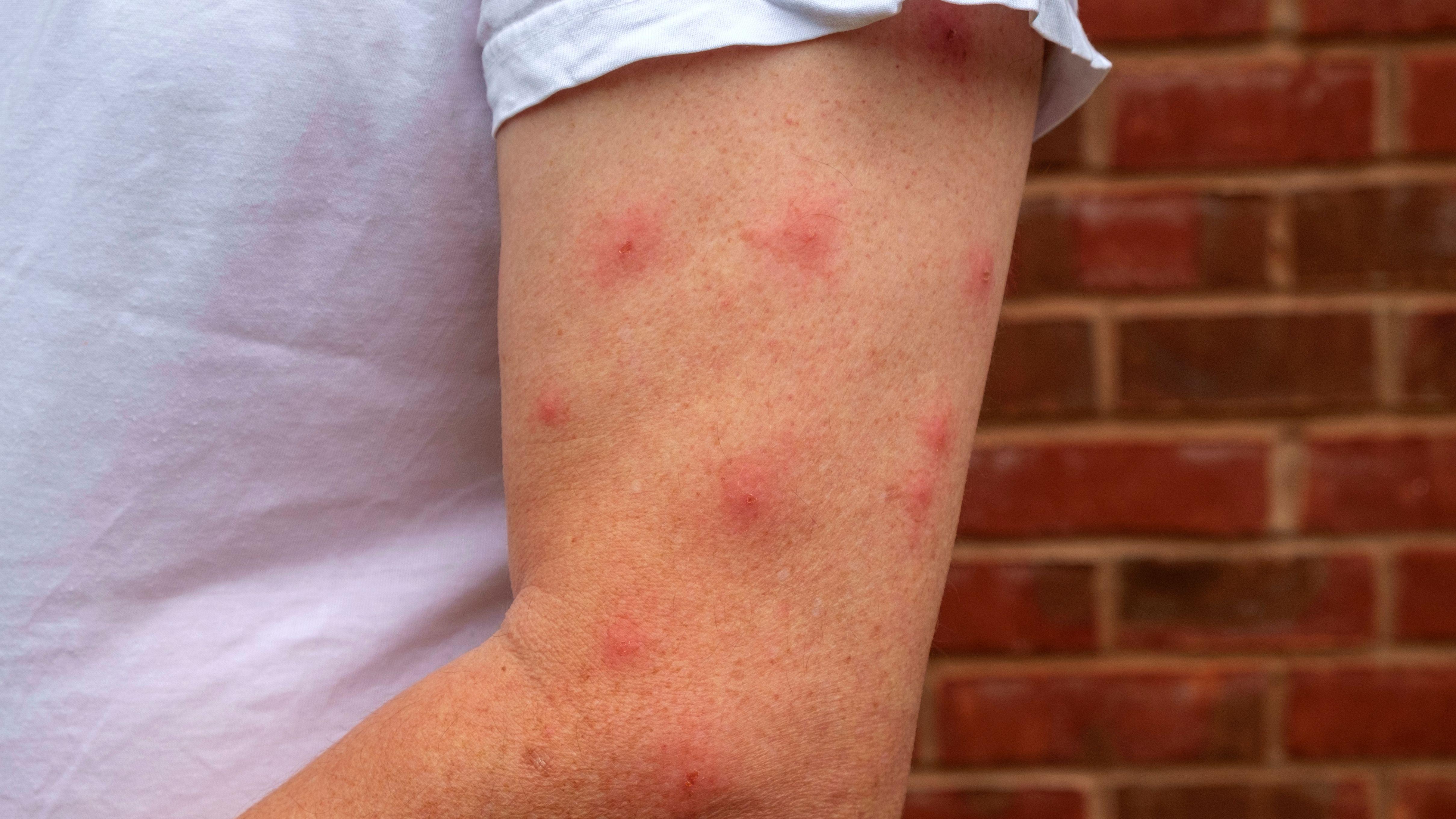 防蚊 蚊子 內分泌新陳代謝科 蚊咬 新陳代謝 羧酸