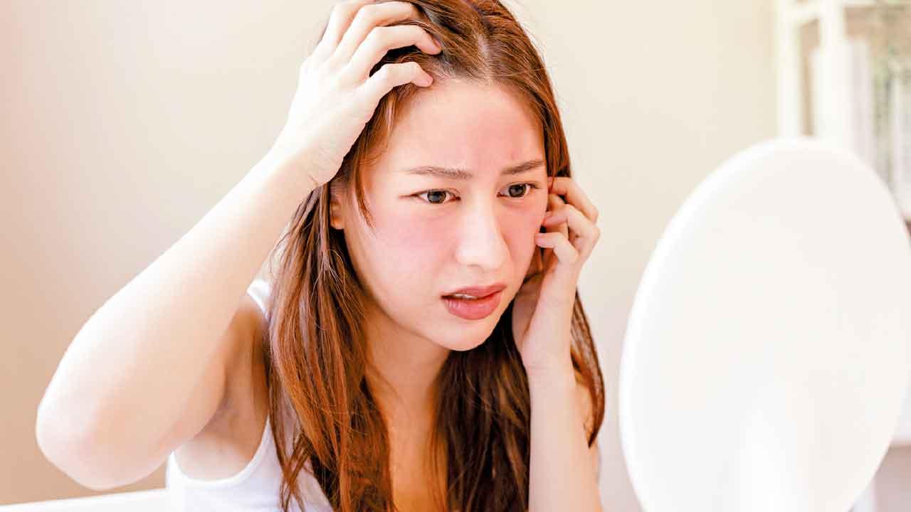 玫瑰痤瘡 處理錯誤易惡化