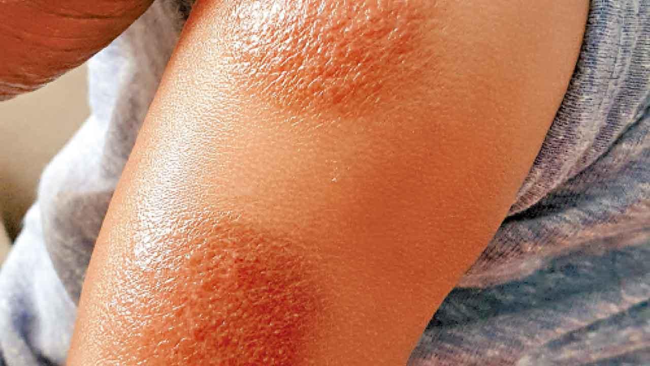 兩年前預測居然成真！嬰兒濕疹後遺症(下)