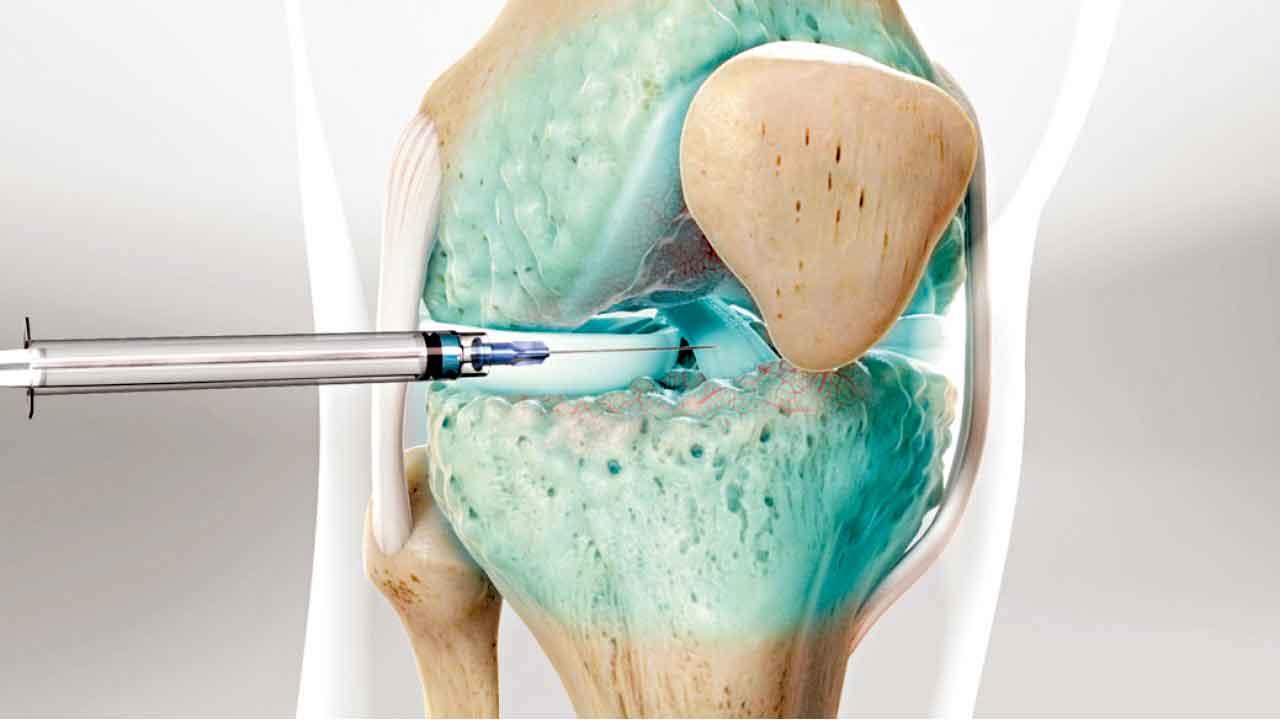 早及中期膝關節退化 新型注射治療方案 