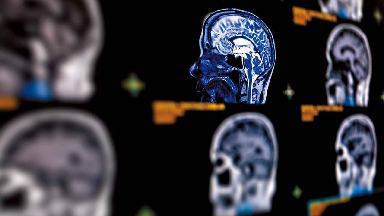 腦內計時炸彈 忽視頭痛死亡率增至五成