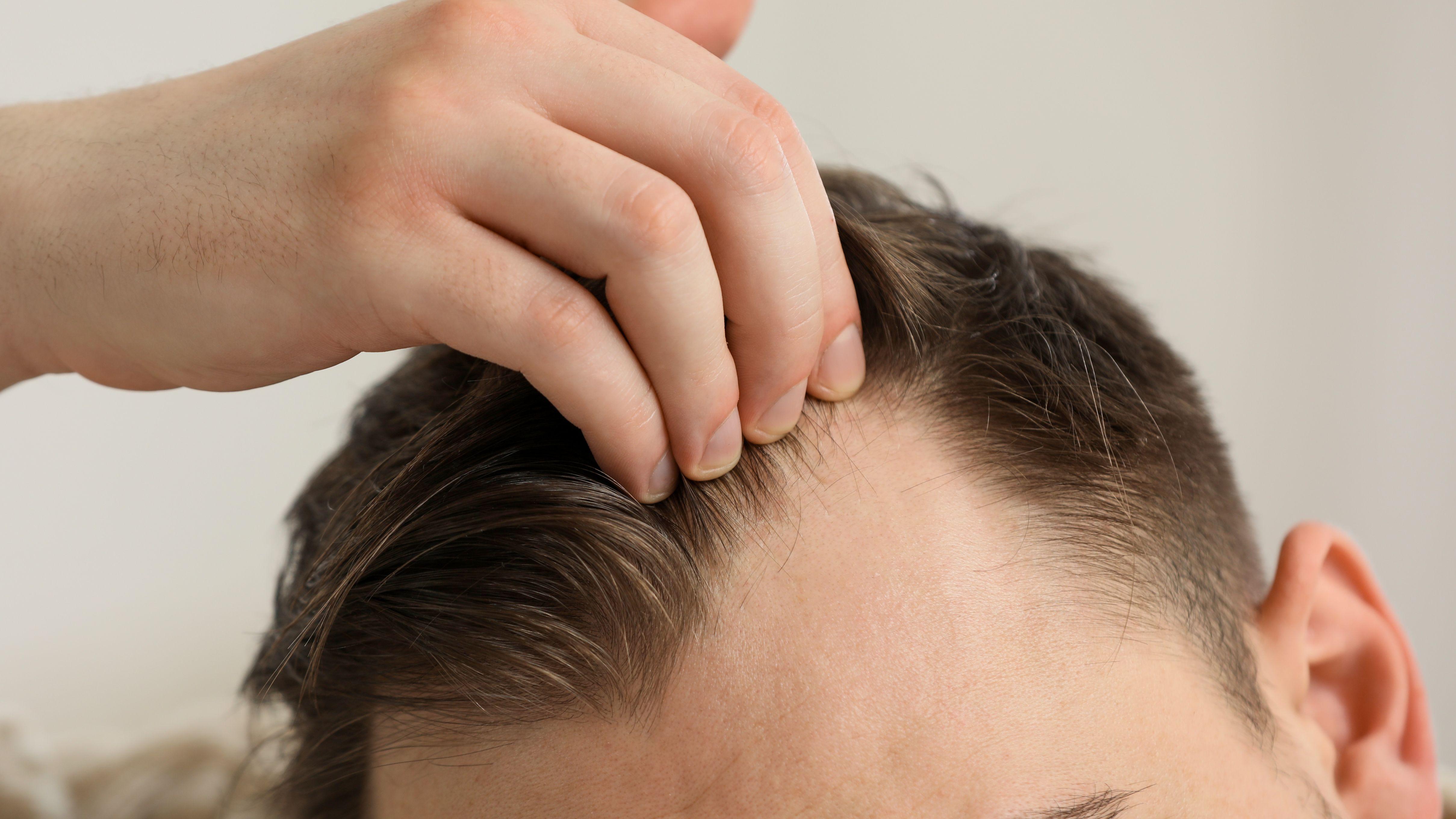 壓力 頭髮  頭髮狀況 壽命 髮線 白髮 脫髮