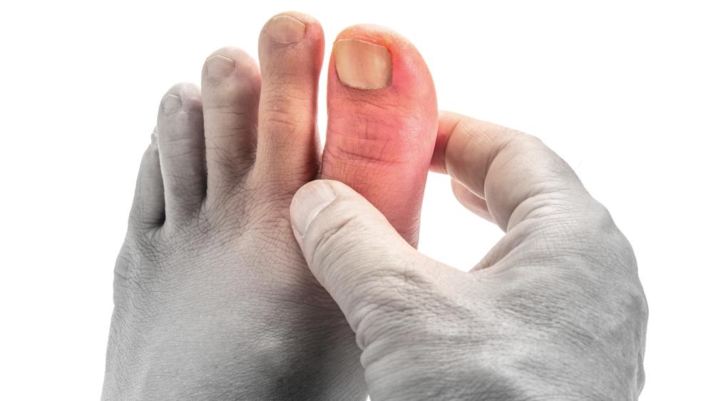 陳昱彰醫生說明，痛風是由於「尿酸過高」引起，而急速減重可能造成代謝異常，導致尿酸濃度上升，進而增加痛風發作的機率。