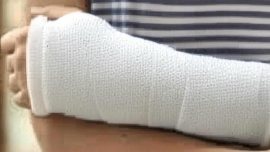 手腕骨折之「三命」