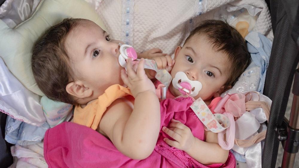 連體女嬰胸盤相連3隻腳，動員60醫護成功分離。(X)