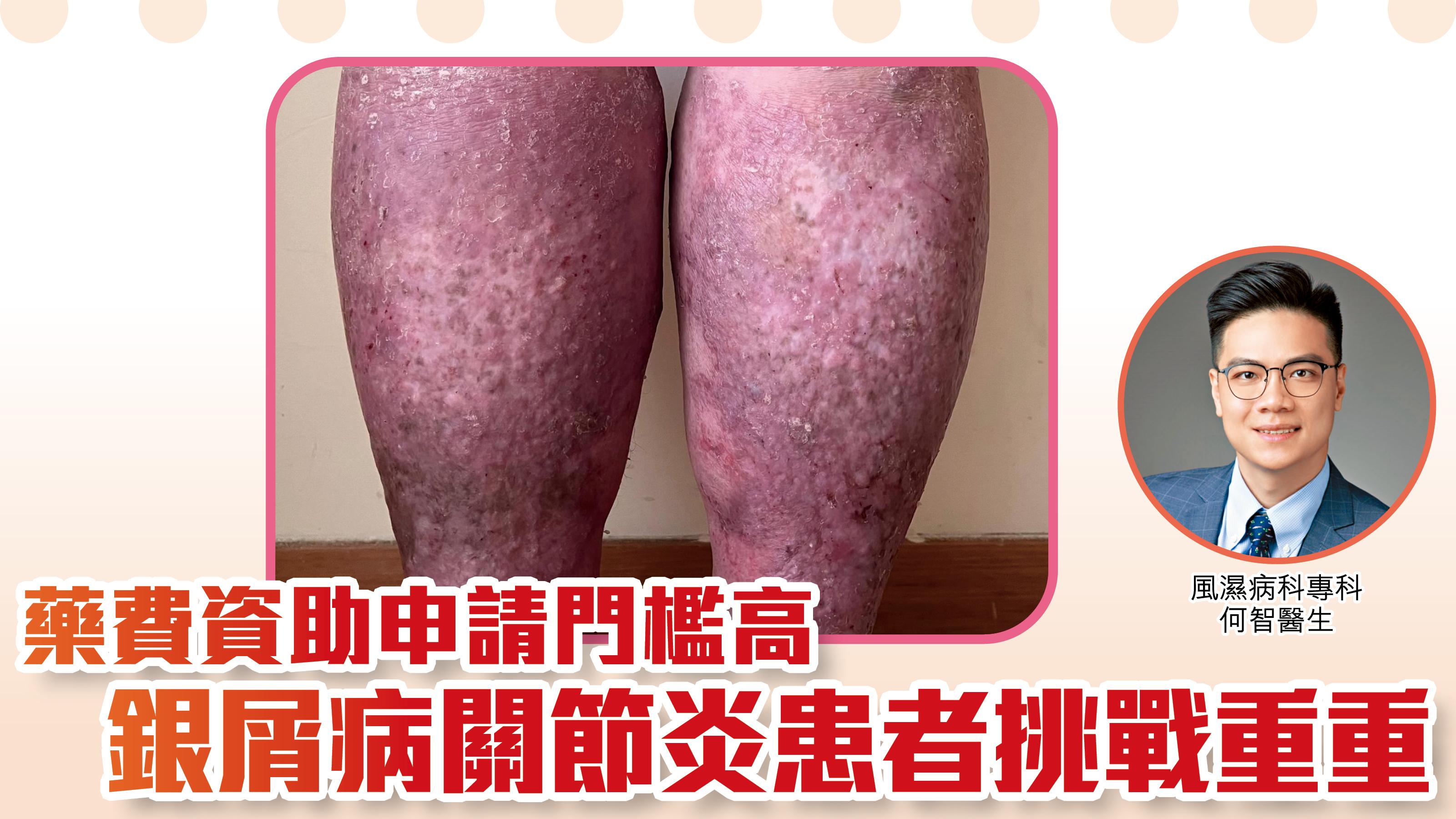 藥費資助申請門檻高 銀屑病關節炎患者挑戰重重