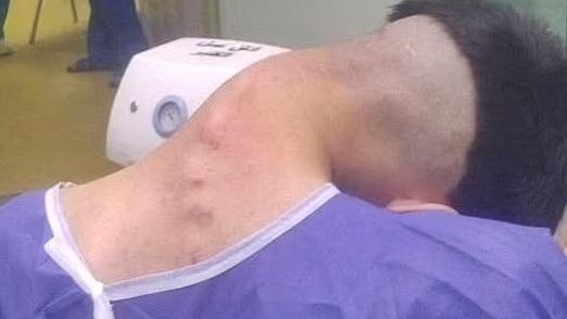 伊朗23歲男過度吸毒 患上恐怖「垂頭症」