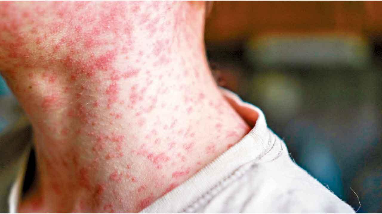 讓美國再次爆發麻疹疫情？