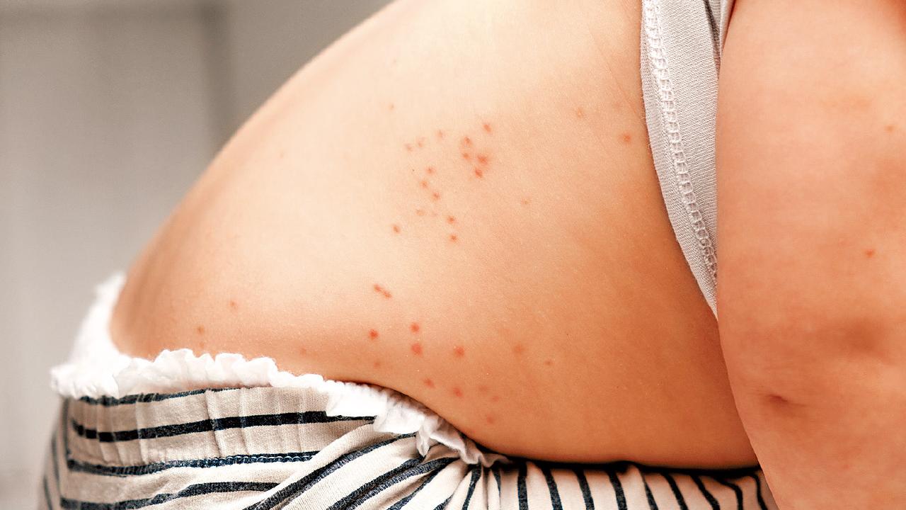 流感新冠交替 注意預防猩紅熱