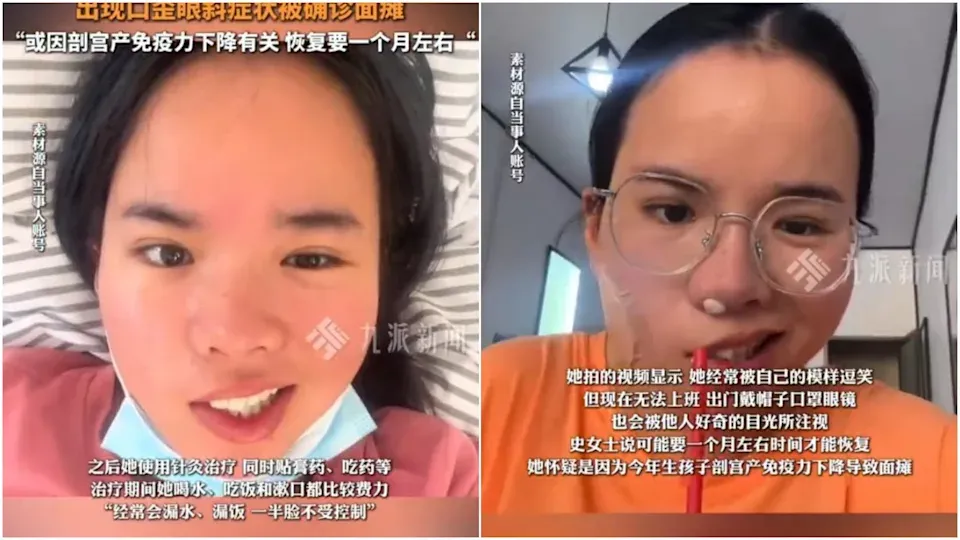 內地女吹風扇入睡醒來竟嘴歪眼斜　醫生指一類人面癱風險高3倍