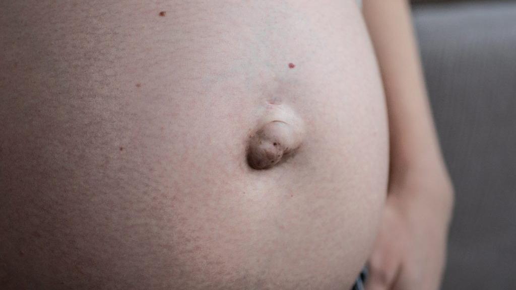 疝氣是體內器官或組織從肌肉或筋膜薄弱處突出，其中以腹部疝氣最常見，分為臍疝氣、腹股溝疝氣及腹壁疝氣。