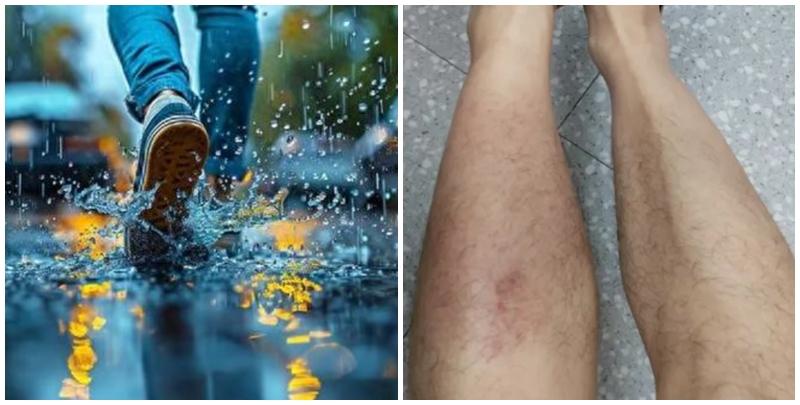 深圳男子蹚水後感染丹毒。 