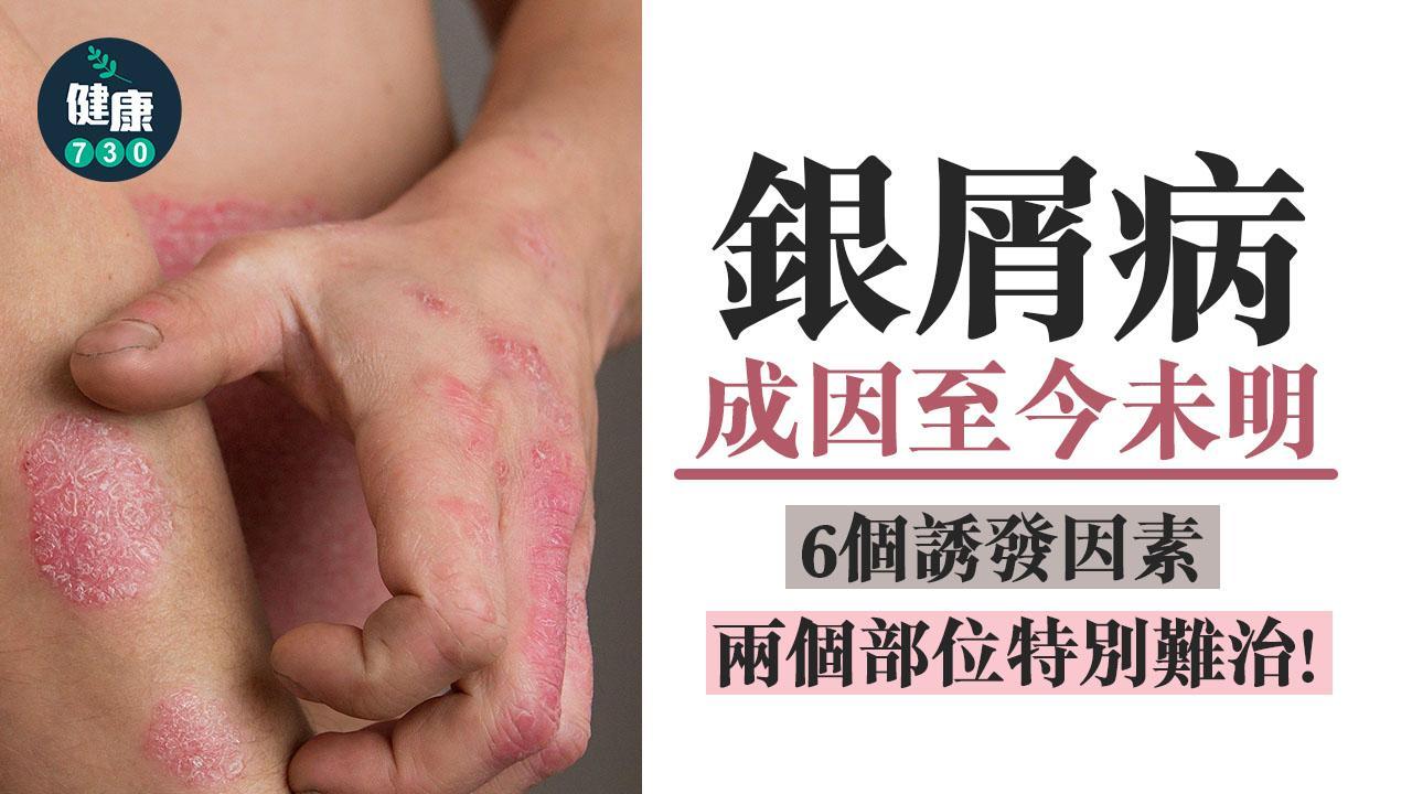 銀屑病｜兩個難治部位 影響皮膚更影響情緒
