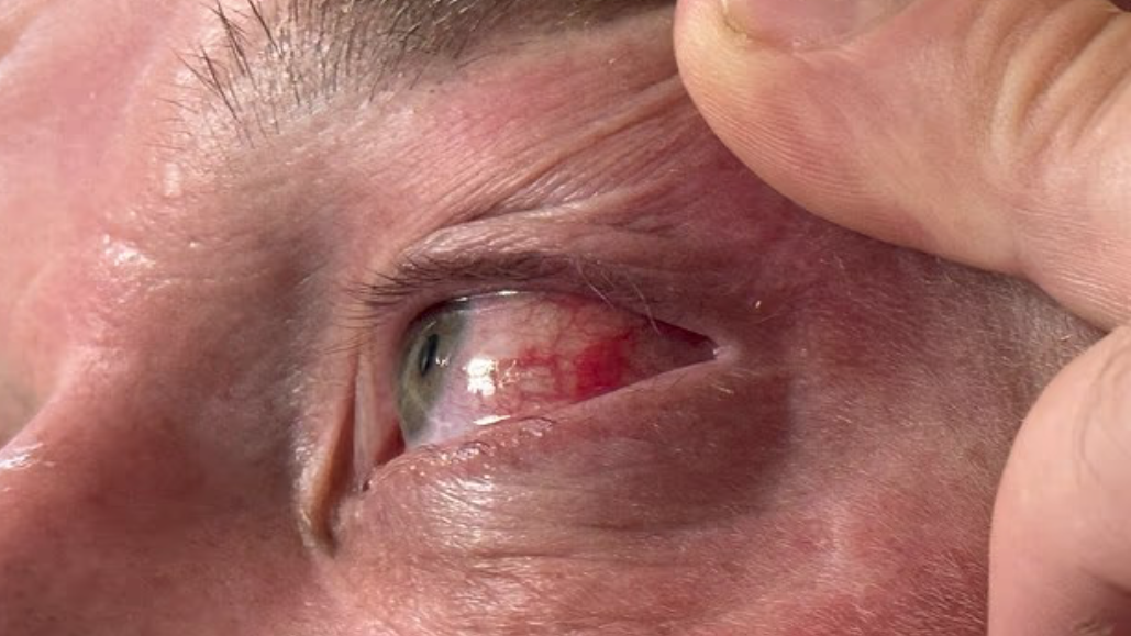 男子眼睛痕癢以為敏感 細看眼白裡面有「它」極驚嚇