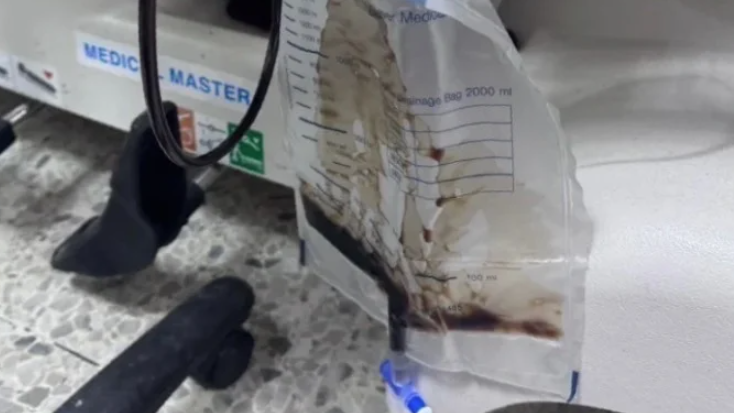 中學生遲交功課遭罰深蹲200次後「痾黑尿」急送院