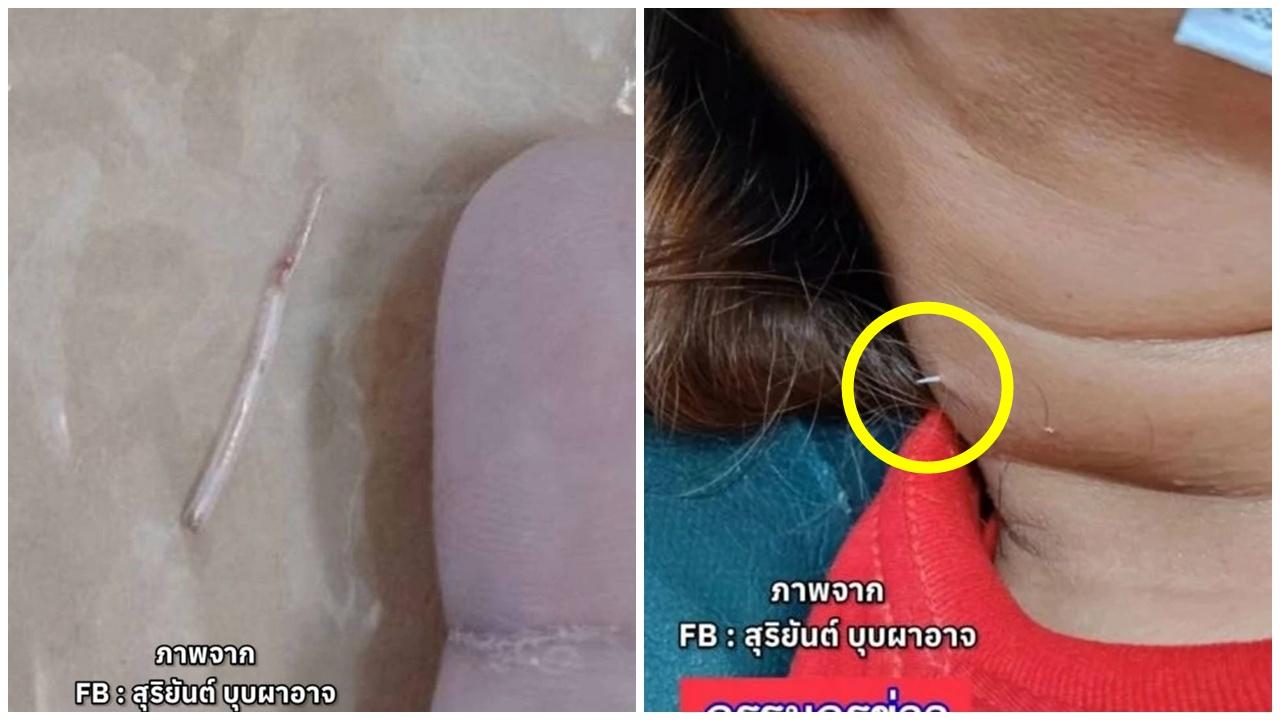 女子飲魚湯誤吞魚骨，2星期後竟刺穿頸部外露。(X)