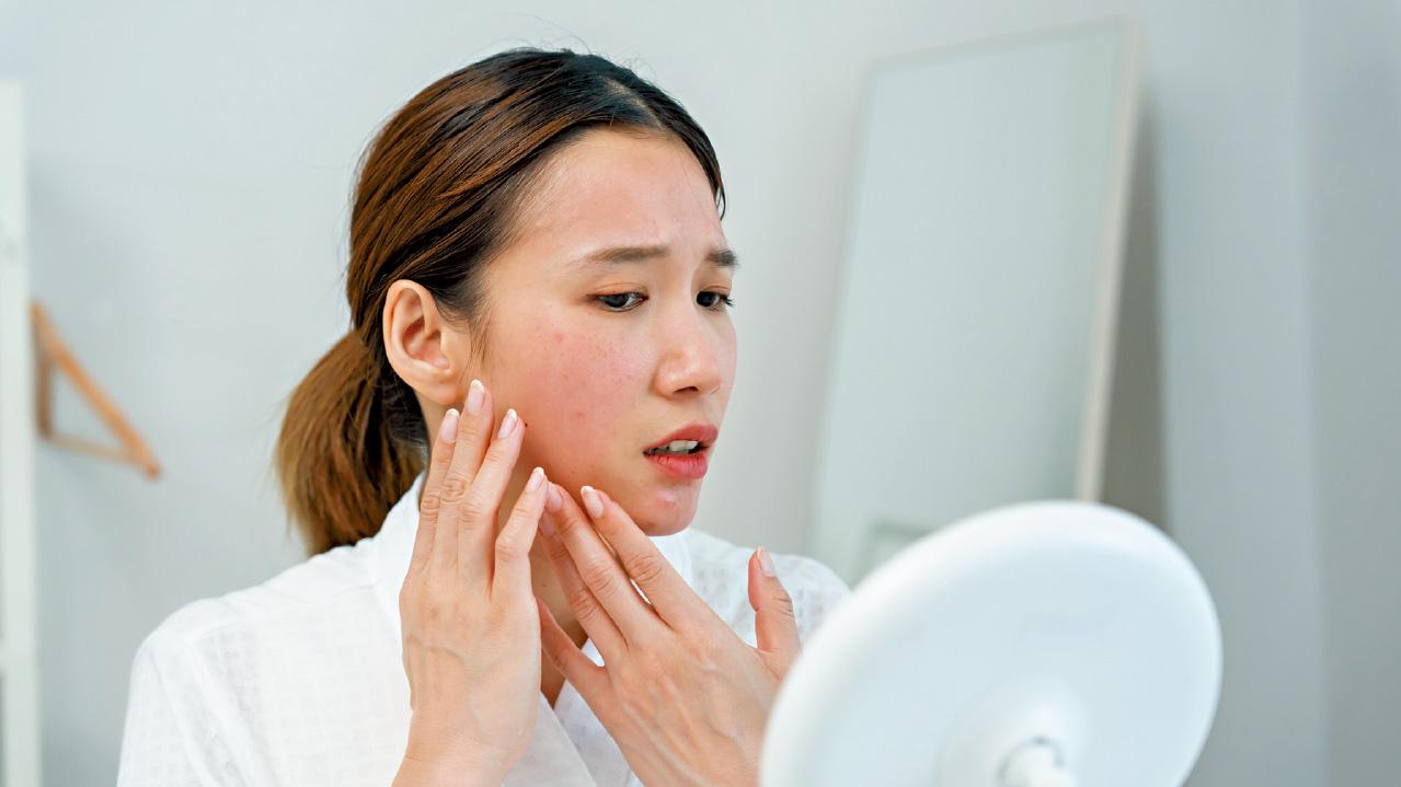 暗瘡要醫 避免留疤