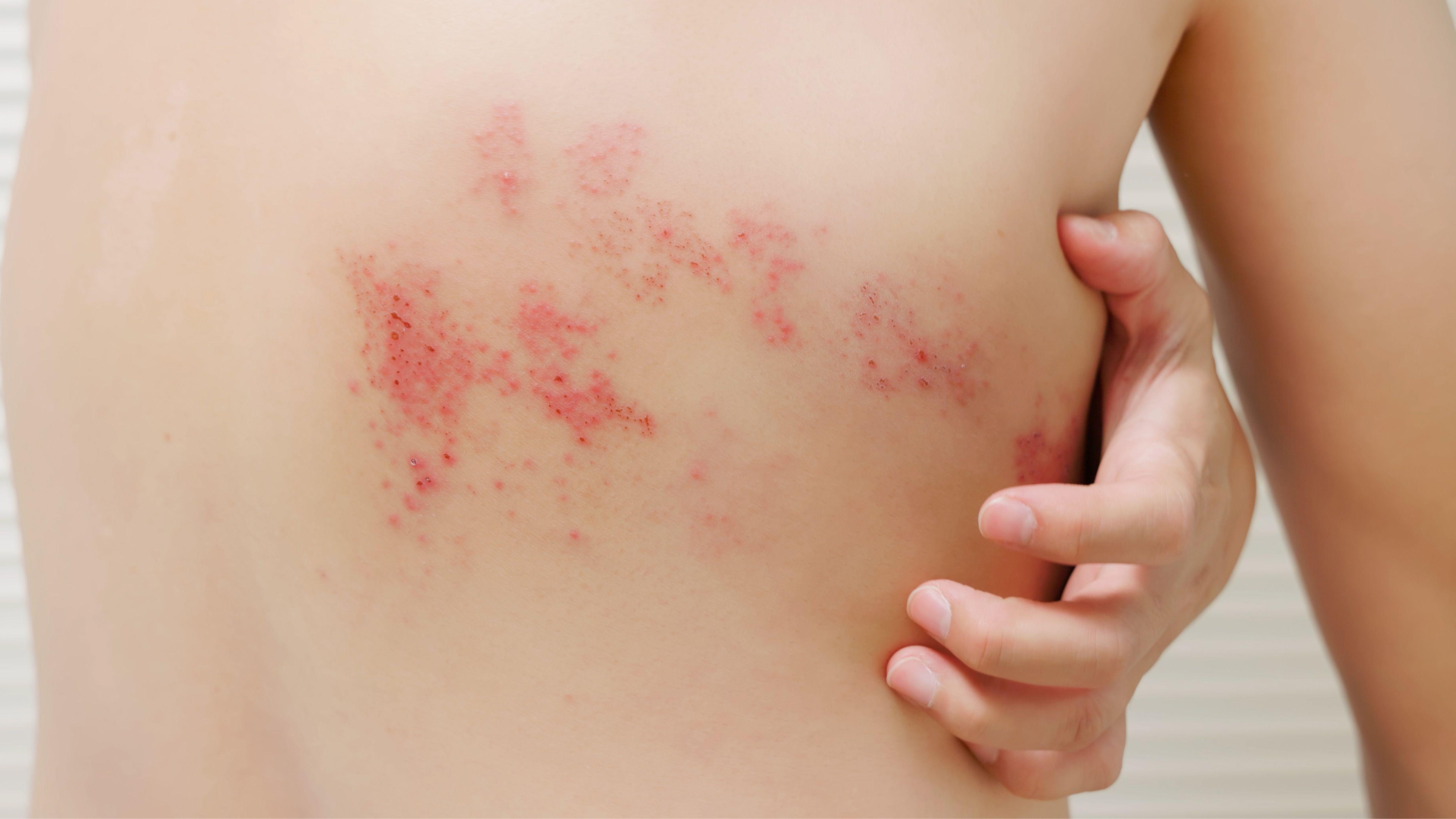 生蛇 帶狀皰疹 水痘病毒 皰疹 免疫力低 紅疹 水泡 過敏 蚊咬 慢性疼痛