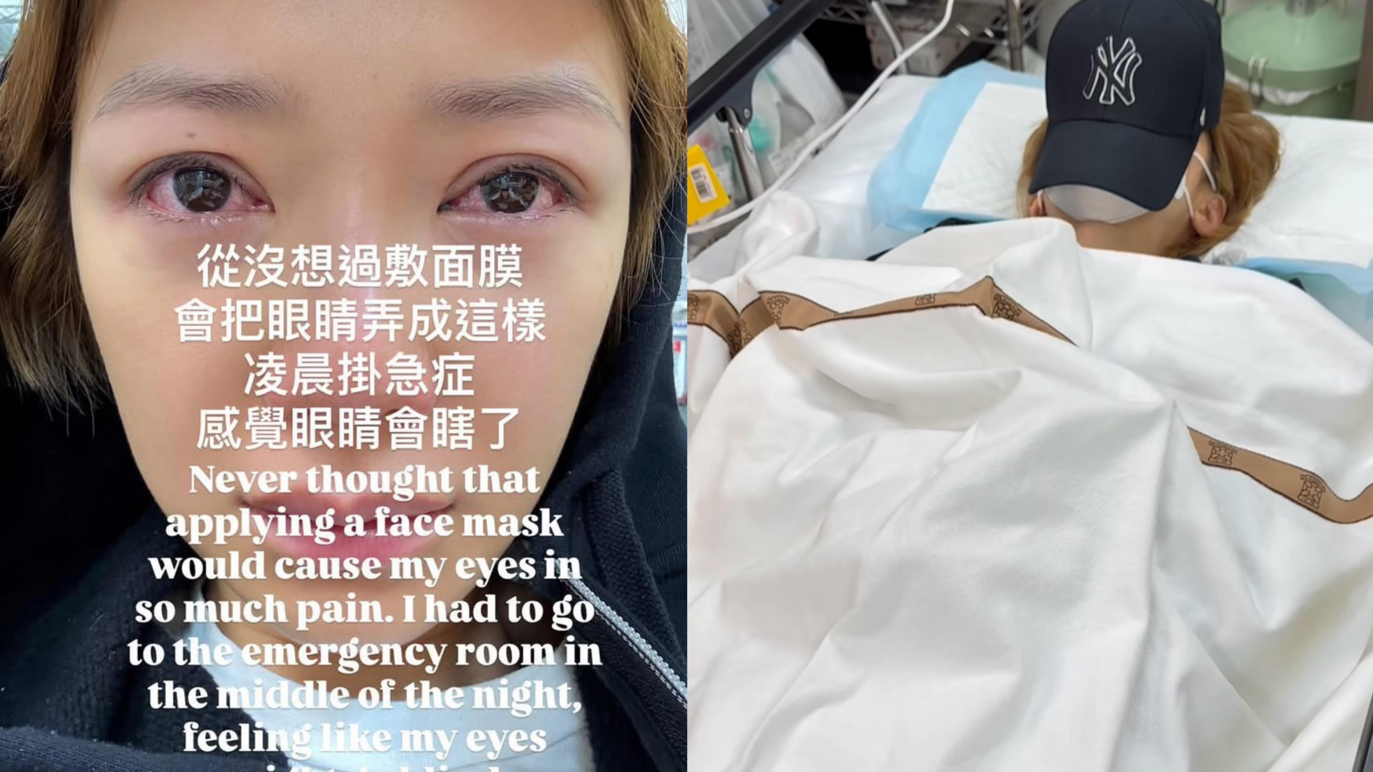 倪晨曦敷面膜出事凌晨睇急症 眼睛劇痛佈滿紅筋險變盲