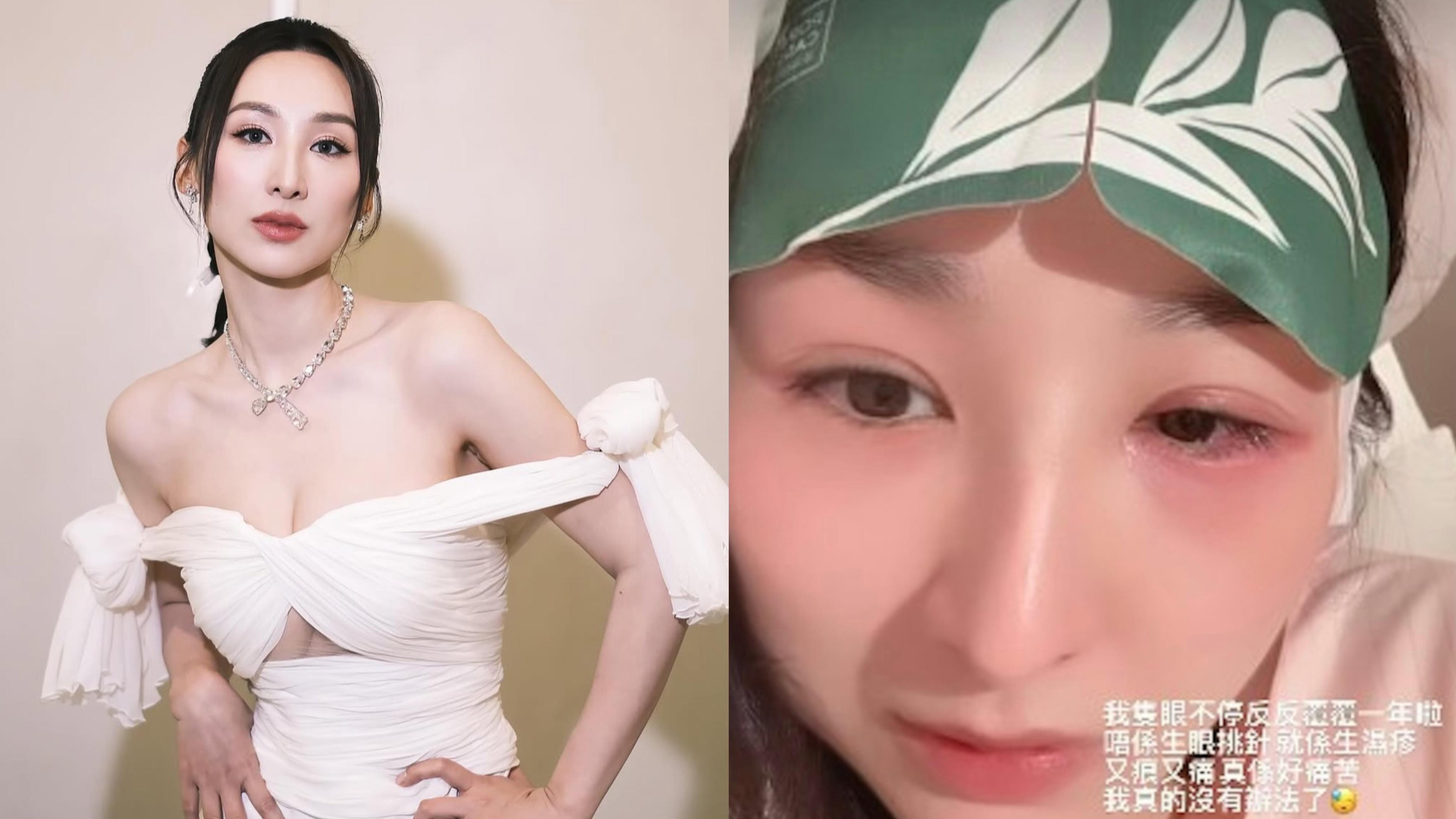 高海寧身體響警號 鬼剃頭後再受眼疾困擾一年大嗌救命