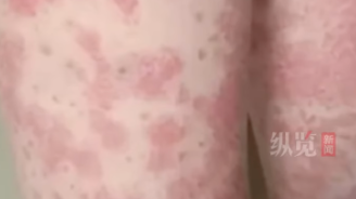 浙江一名愛美女生頻繁染髮，兩年後竟患上腎炎。（示意圖／unsplash）