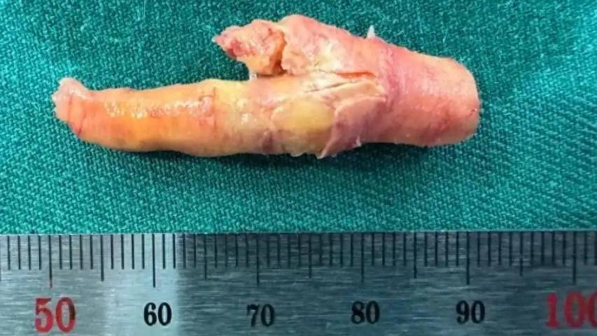 浙江漢每日2包煙頸動脈狹窄 手術取出「鳳爪狀硬塊」