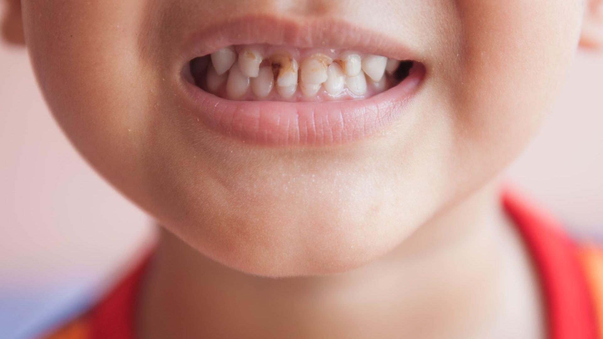 染色不等於「免蛀」，若口腔衛生不佳，還是會發生齲齒。