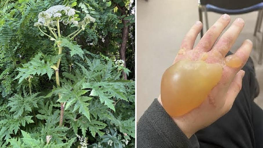 川崎映貼出在北海道大學發現的疑似大豕草，誤觸後手部起巨大水泡的照片。(互聯網)
