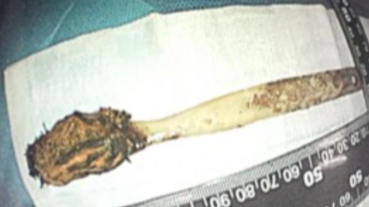 醫生動手術，替楊姓男子取出52年前的兒童牙刷。(互聯網)