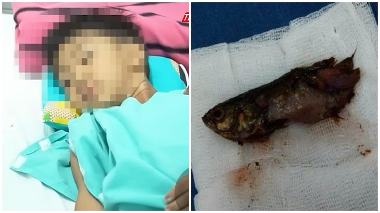 4歲童戲水忽然狂咳吐血，開刀拿出7厘米活魚。(X)