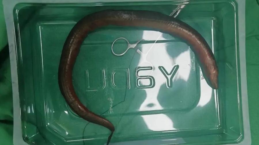 30厘米長黃鱔離奇鑽入肛門，湖南漢被鑽破腸道險死。(微博)