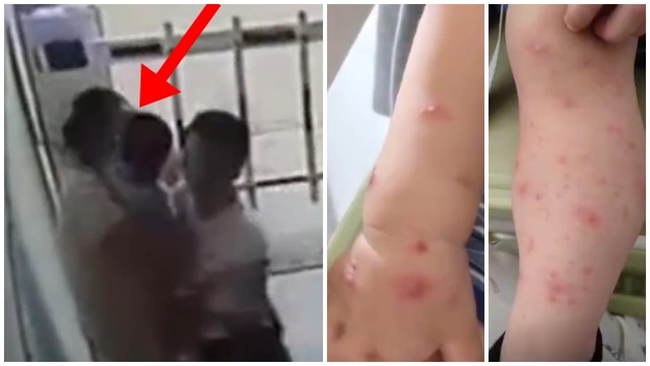 1歲男童遭強吻當晚發高燒再出水痘，陌生女疑涉迷信疾病轉移。(微博)