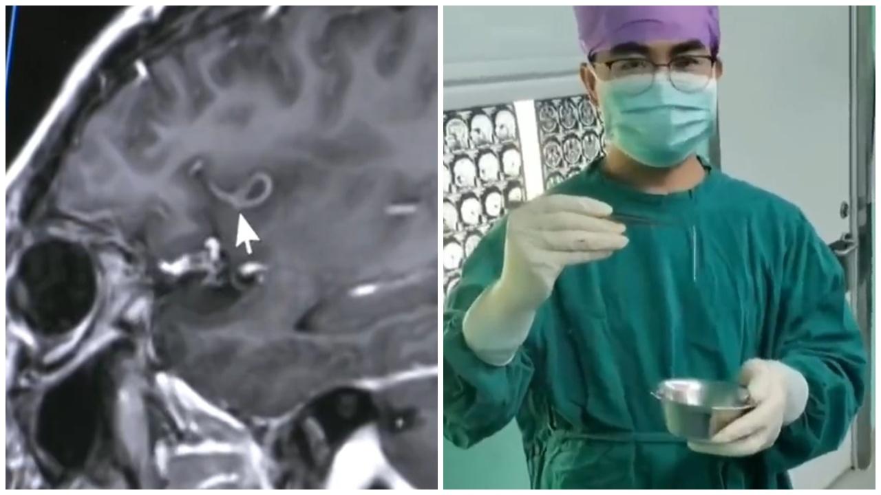 男子釣魚突抽搐失語，開腦驚見10厘米活蟲蠕動。(微博)