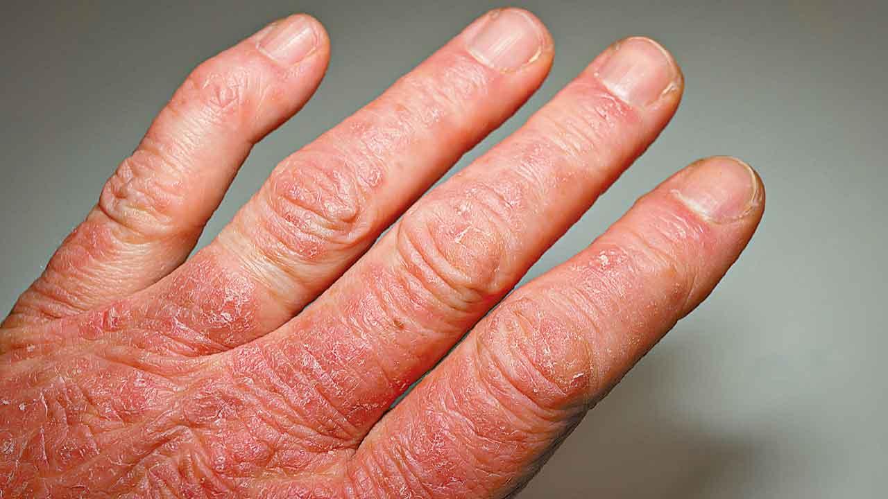 銀屑病侵蝕關節 治療有助骨質修復