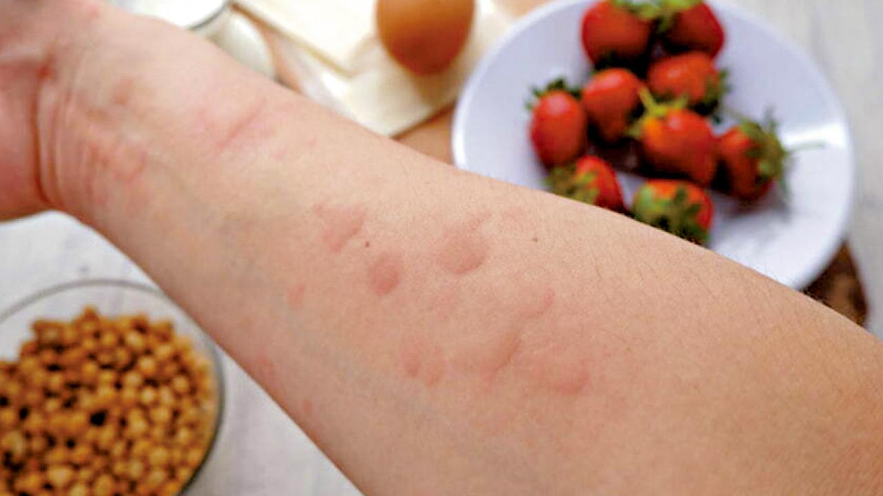 食物過敏與營養