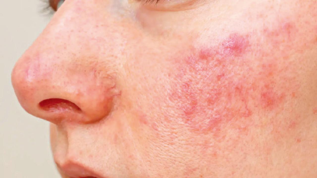 暗瘡與玫瑰痤瘡：深入探討與辨別