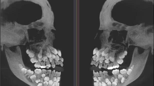 巴西傳出11歲女童牙齒多達81顆。（示意圖/資料照片）