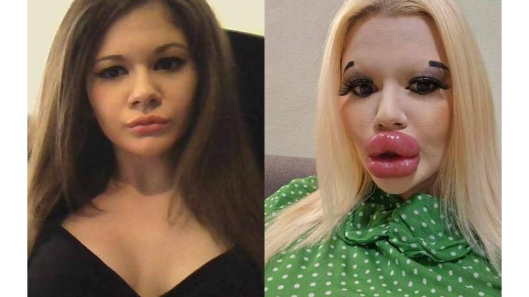 整容｜保加利亞網紅接受32項整形手術 狂打玻尿酸致「香腸嘴」