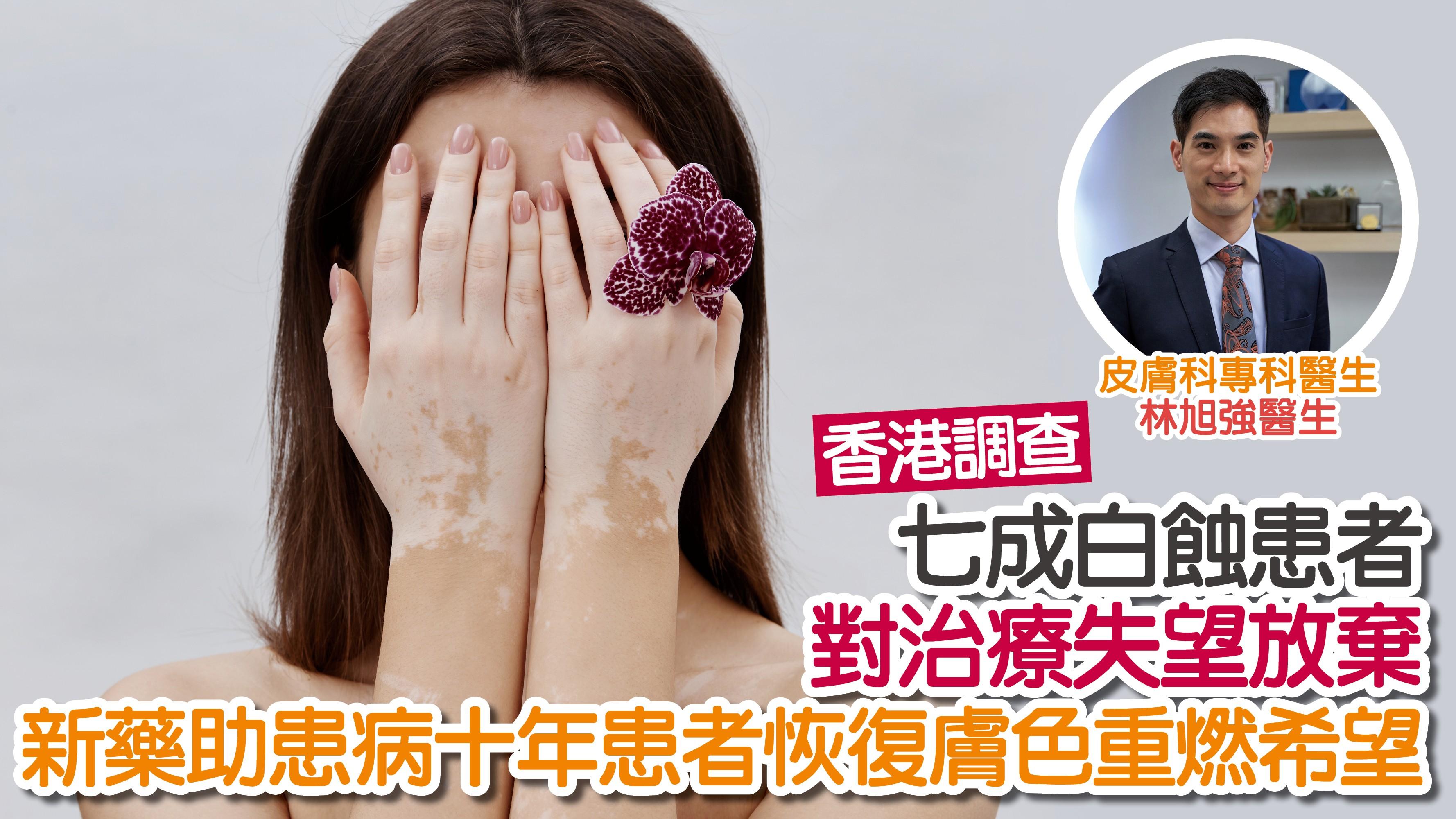 香港調查：七成白蝕患者對治療失望放棄 新藥助患病十年患者恢復膚色重燃希望